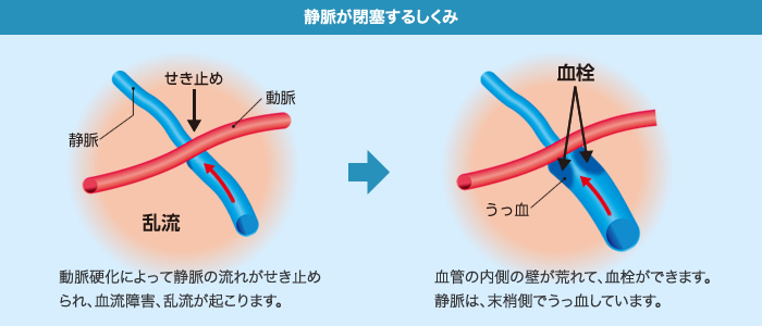 大阪府茨木市、永井眼科の網膜静脈閉塞症