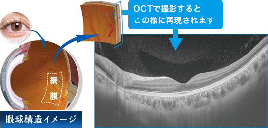 OCT】新世代の3次元眼底検査 - 永井眼科｜大阪府茨木市｜白内障手術 