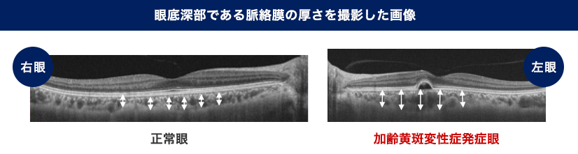 大阪府茨木市、永井眼科の3次元眼底検査