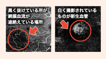 大阪府茨木市、永井眼科の3次元眼底検査