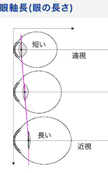 大阪府茨木市の眼科で白内障日帰り手術