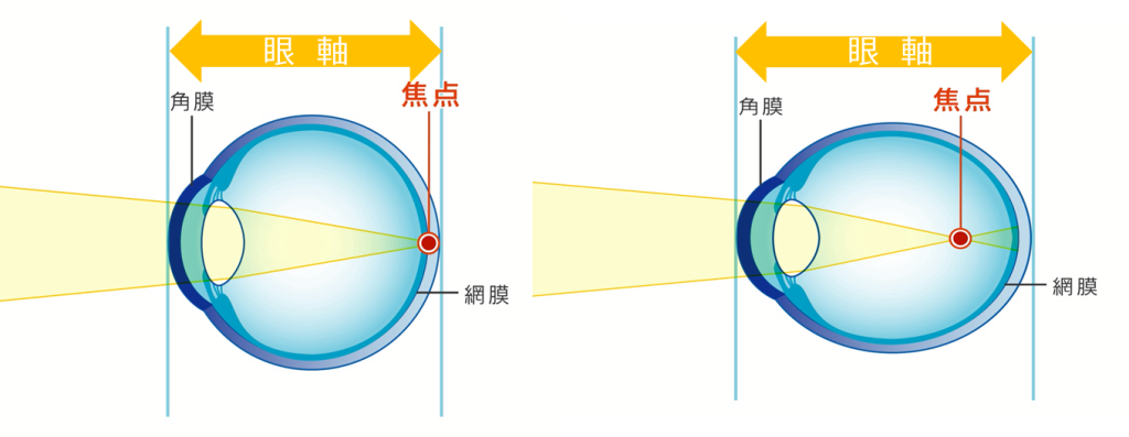 大阪府茨木市の眼科で近視抑制治療