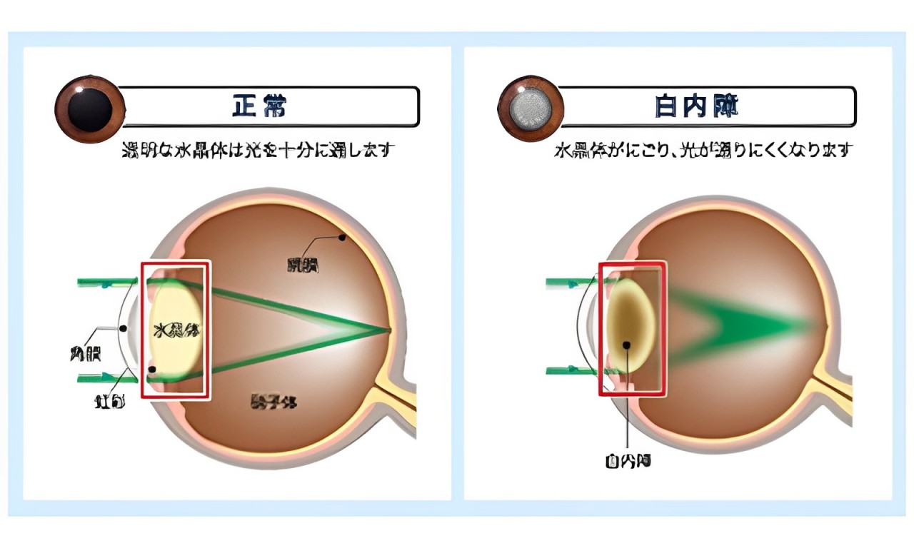 大阪府茨木市の眼科の白内障治療