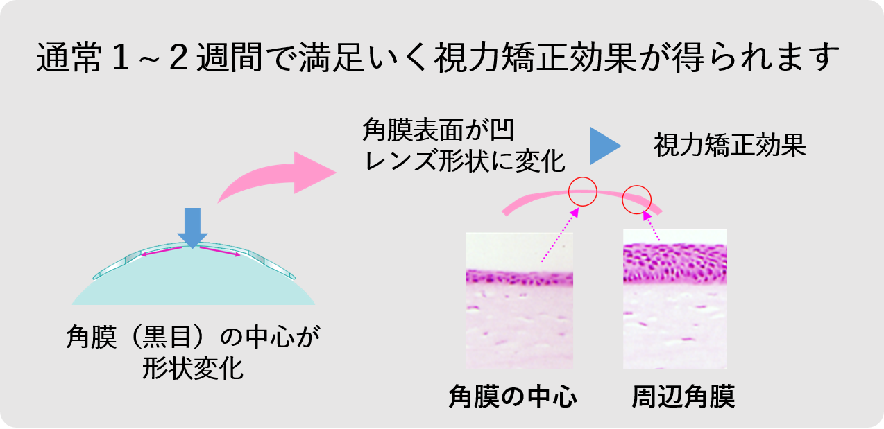 大阪府茨木市の眼科でオルソケラトロジー治療