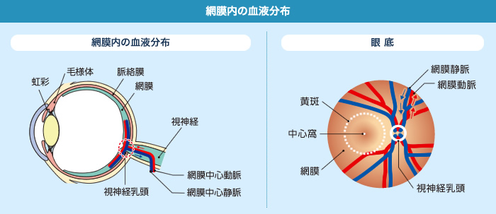 大阪府茨木市、永井眼科の網膜静脈閉塞症