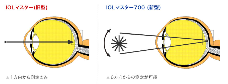 大阪府茨木市の眼科で白内障日帰り手術