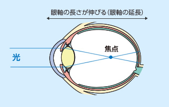 強度近視の眼球の図